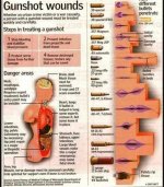 A Pioneer in Gunshot Wound Treatment