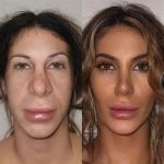A Visual Guide to Plastic Surgery Transformations