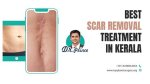 Exceptional Kidney Removal Scar Treatment: Minimizing Discomfort and Enhancing Outcomes