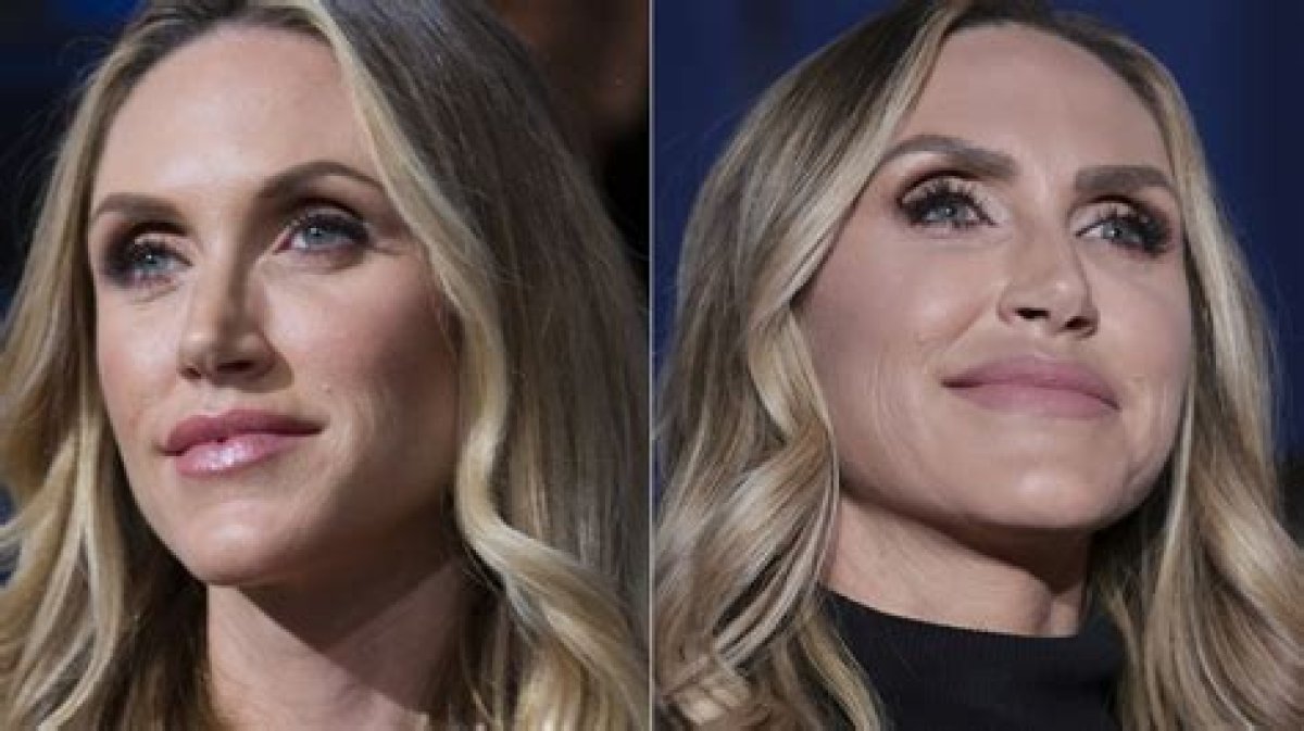 Lara Trump Plastic Surgery Before and After Transformation: the Full Story You Need to Know