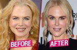 Nicole Kidman Facelift: a Comprehensive Look at Her Transformation and Impact on the Beauty Industry