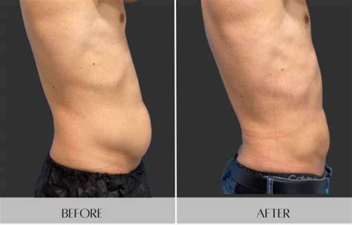 Pictures of Pah After Coolsculpting