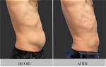 Pictures of Pah After Coolsculpting