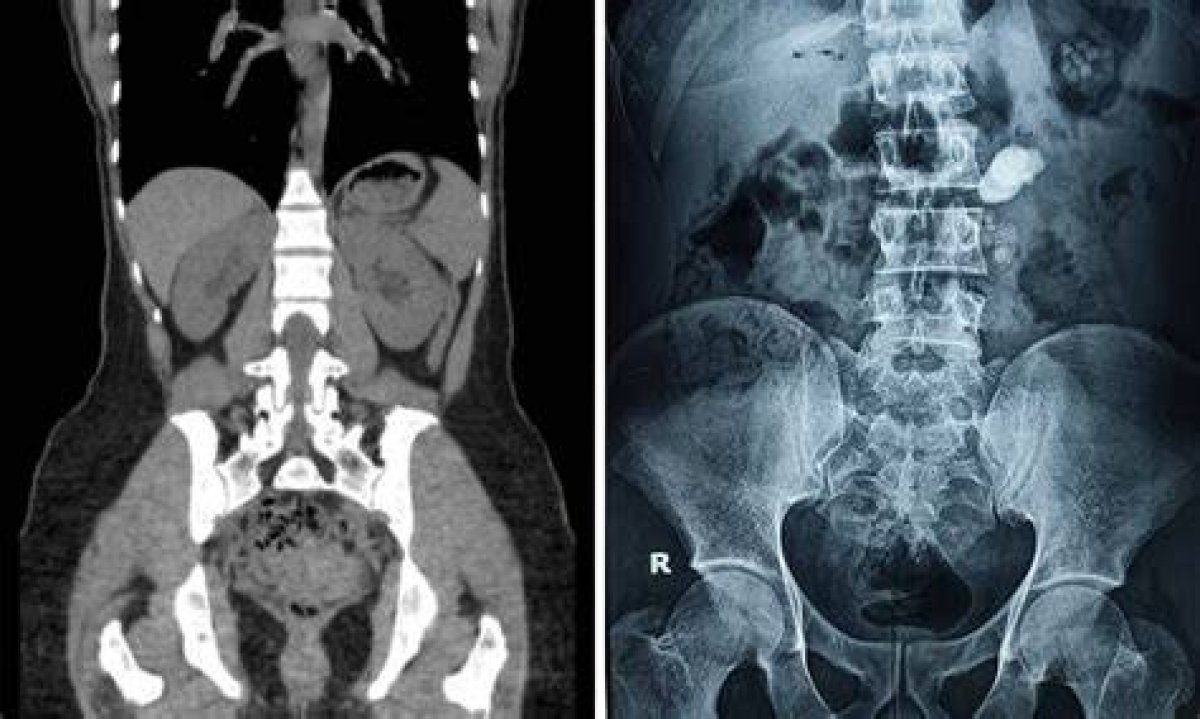 Ultimate Guide to Understanding Kidney Surgery Scarring