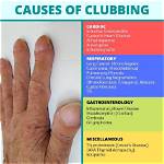Understanding Clubitis Disease Symptoms in Adults: a Comprehensive Guide